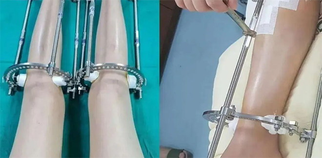 新华网评:别被“断骨增高”忽悠瘸了